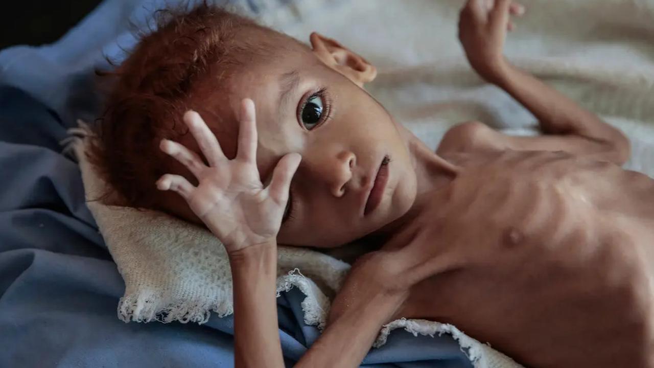 Hati-hati Rawan Malnutrisi Pada Anak, Cegah Sedari Dini