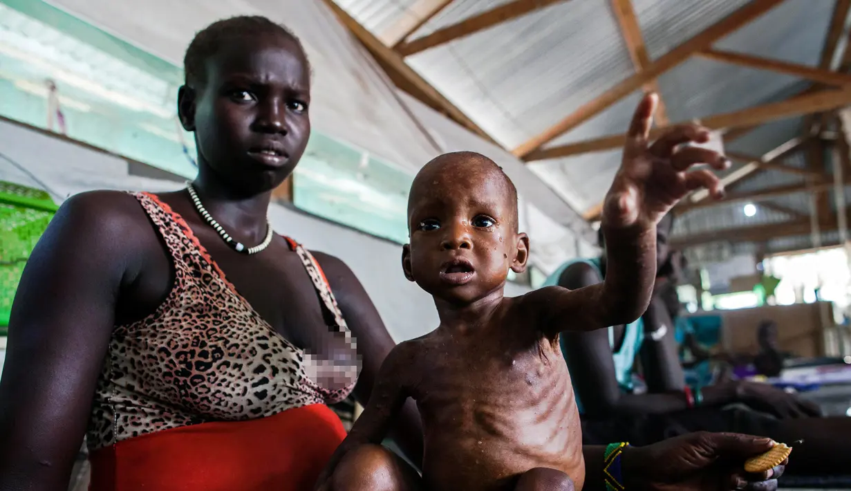 Seorang wanita memegang anaknya yang terkena penyakit gizi burutk di sebuah klinik di Lankien, Sudan Selatan, (8/4). Menurut MSF, Kekurangan gizi didaerah sudan selatan sudah mencapai batas kritis. (Albert Gonzalez Farran / cds / AFP)