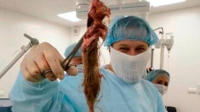 Mengeluh Sakit Perut, Dokter Temukan Kista Berisi Gumpalan Rambut dari Indung Telur Wanita Ini