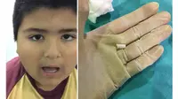 Seorang dokter di Argentina, menemukan squaker di dalam tubuh anak laki-laki berusia 8 tahun (facebook/santiago gomez)