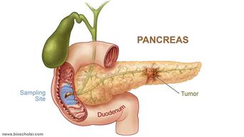 10 Tanda-Tanda Kanker Pankreas yang Wajib Dikenali, Kerap Sulit Dideteksi