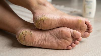 7 Cara Mengatasi Tumit Pecah-Pecah dengan Perawatan Rumahan, Kaki Kasar Jadi Lebih Halus