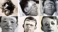 Tidak seperti sekarang, dahulunya operasi plastik dilakukan untuk memperbaiki muka yang rusak akibat perang