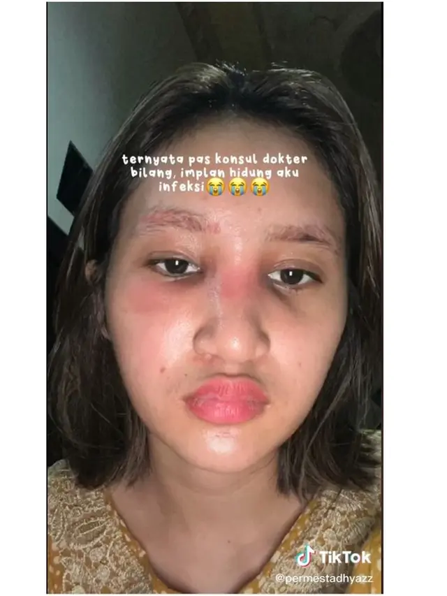 6 Potret Kronologi Dhyaz Anak Farida Nurhan Alami Infeksi Hidung Pasca Implan