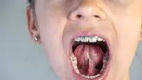 Tongue Tie adalah Gangguan Tali Lidah yang Bisa Picu Masalah pada Anak, Simak Penangannya!