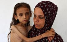 FOTO: Potret Pedih Mariam Anak 9 Tahun, Korban Kelaparan Gaza