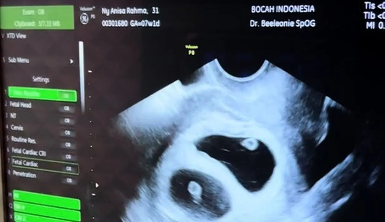 Anisa Rahma dan Anindito (Instagram/ananditodwis)