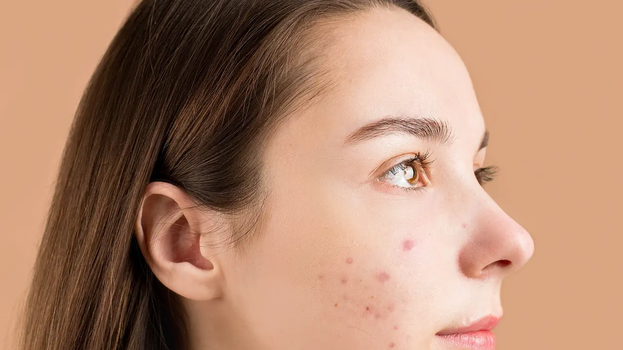 ilustrasi jerawat (Photo by Anna Nekrashevich: https://www.pexels.com/photo/close-up-photo-of-a-teenager-with-pimples-on-her-face-6476065/)