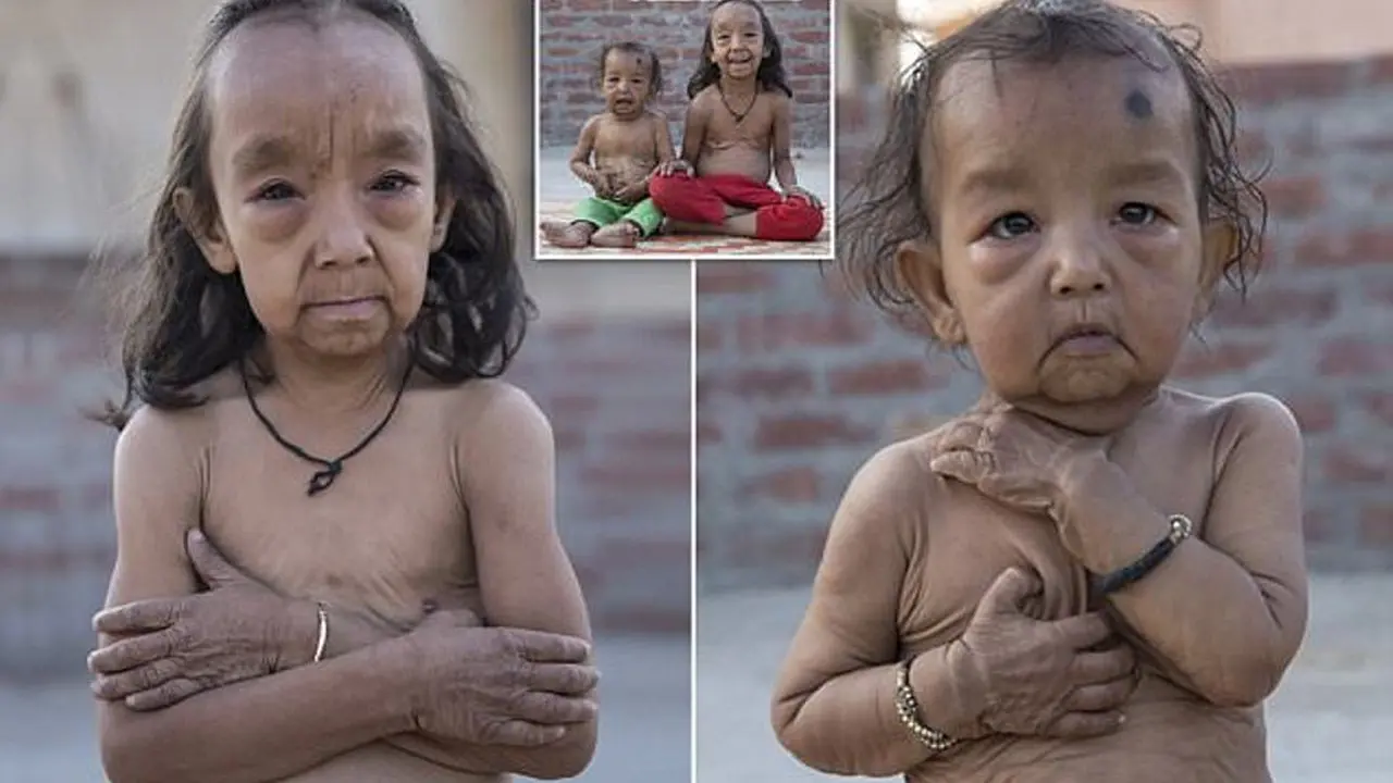 Dua Bocah Ini Alami Penuaan Dini, Titisan Benjamin Button?