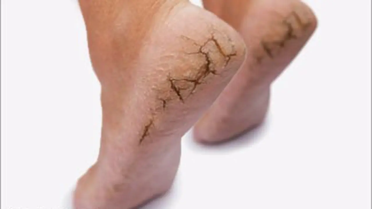 Kulit Kaki Kering & Pecah Tanda Kurang Vit B