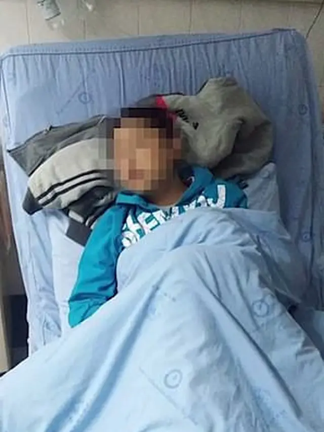Bocah 12 Tahun Idap Penyakit Mirip Drakula, Bila Terkena Sinar Matahari