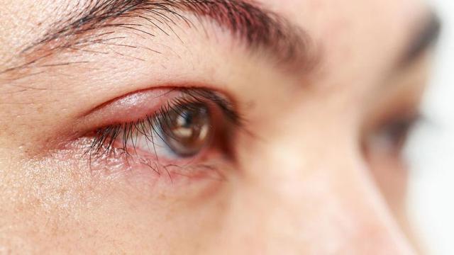 5 Penyebab Mata Bintitan Terus Menerus dan Cara Mengatasinya