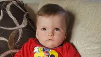 Derita Sindrom Langka, Bayi Ini Tak Bisa Senyum
