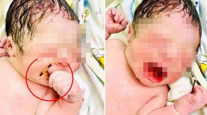 Viral Bayi Lahir Sambil Pegang Alat Kontrasepsi Ibunya - Citizen6 ...