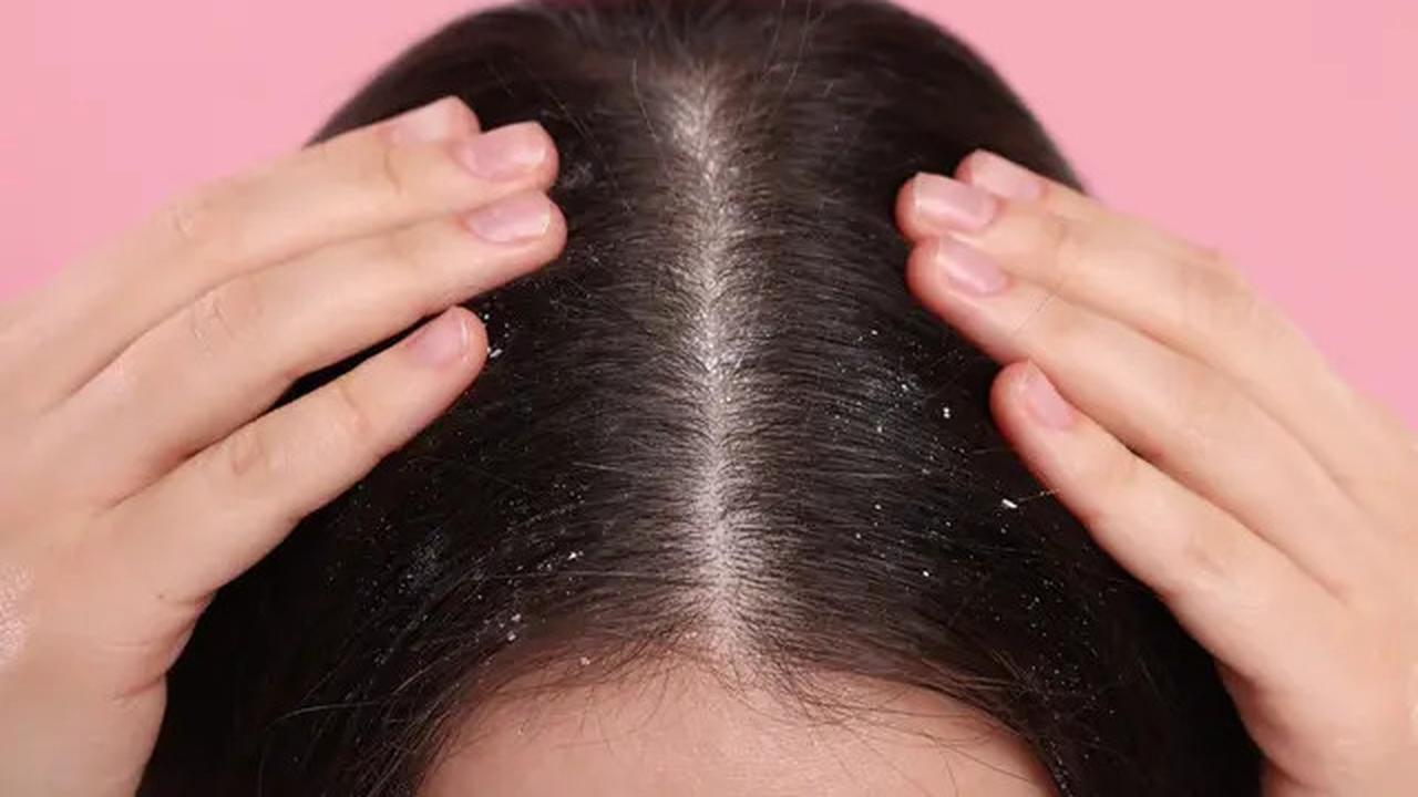6 Manfaat Nanas untuk Kesehatan Rambut, Kurangi Ketombe Hingga Bikin Berkilau