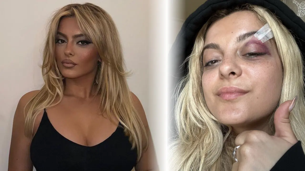 Bebe Rexha terluka