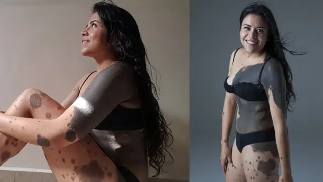 [Bintang] Kisah Wanita yang Ingin Bunuh Diri karena Memiliki Tanda Lahir Hampir di Sekujur Tubuh