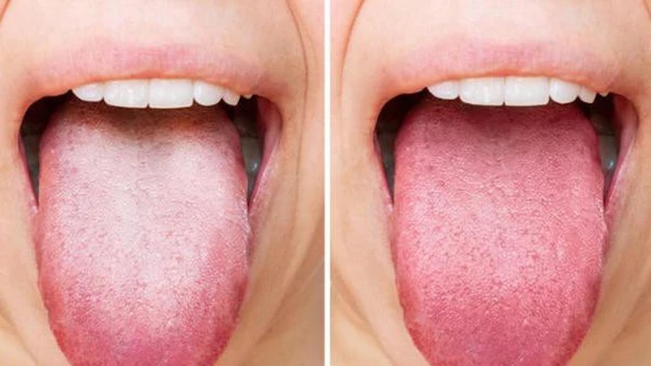 Warna Lidah Bisa Jadi Cermin Kesehatan Tubuh, Begini Cara Mengenalinya