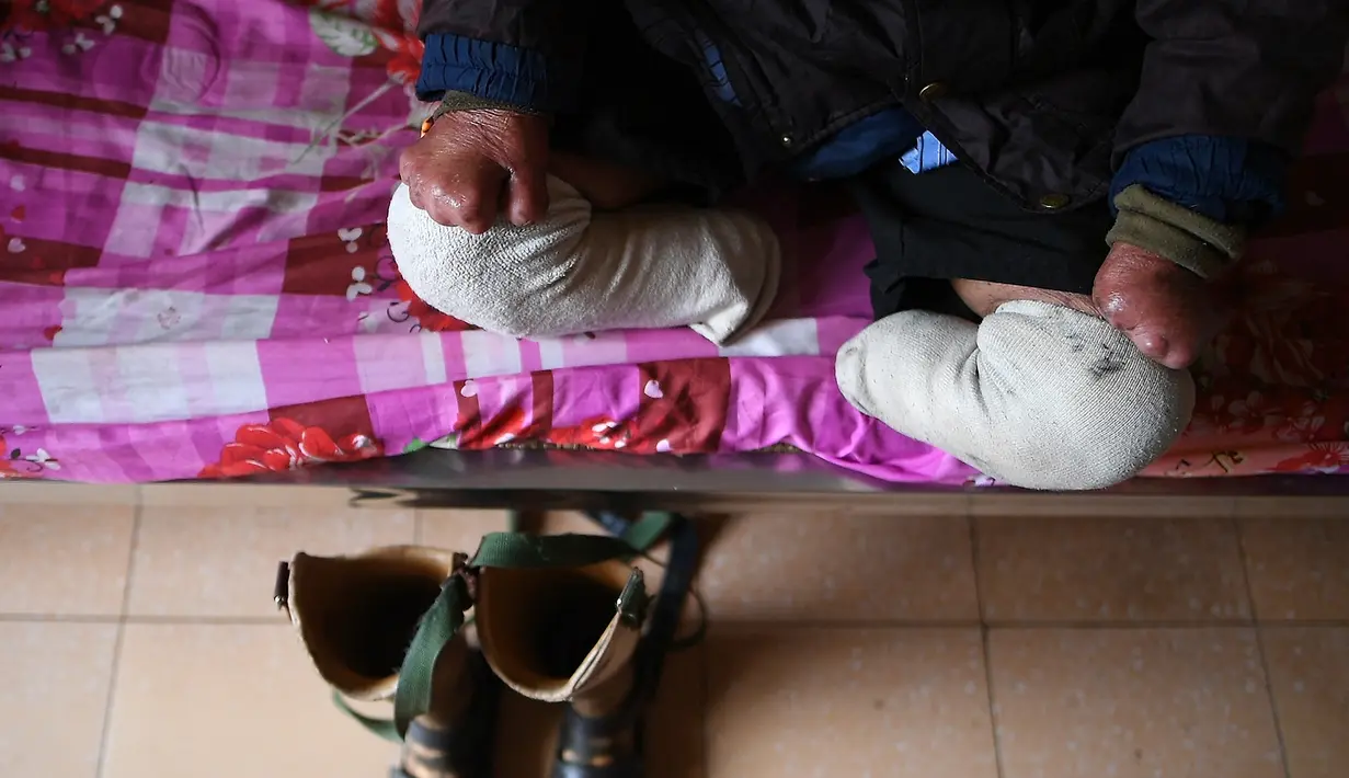 Penderita kusta duduk di ranjang kompleks RS Van Mon Leprosy, Thai Binh, Vietnam, Minggu (20/1). RS Van Mon Leprosy pernah menangani hingga 4.000 pasien dalam setahun. (Manan Vatsyayana/AFP)
