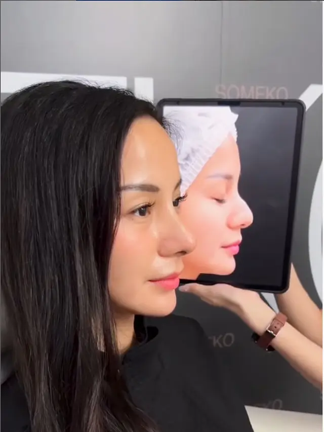6 Potret Terbaru Kirana Larasati Usai Rhinoplasty, Akui untuk Estetika