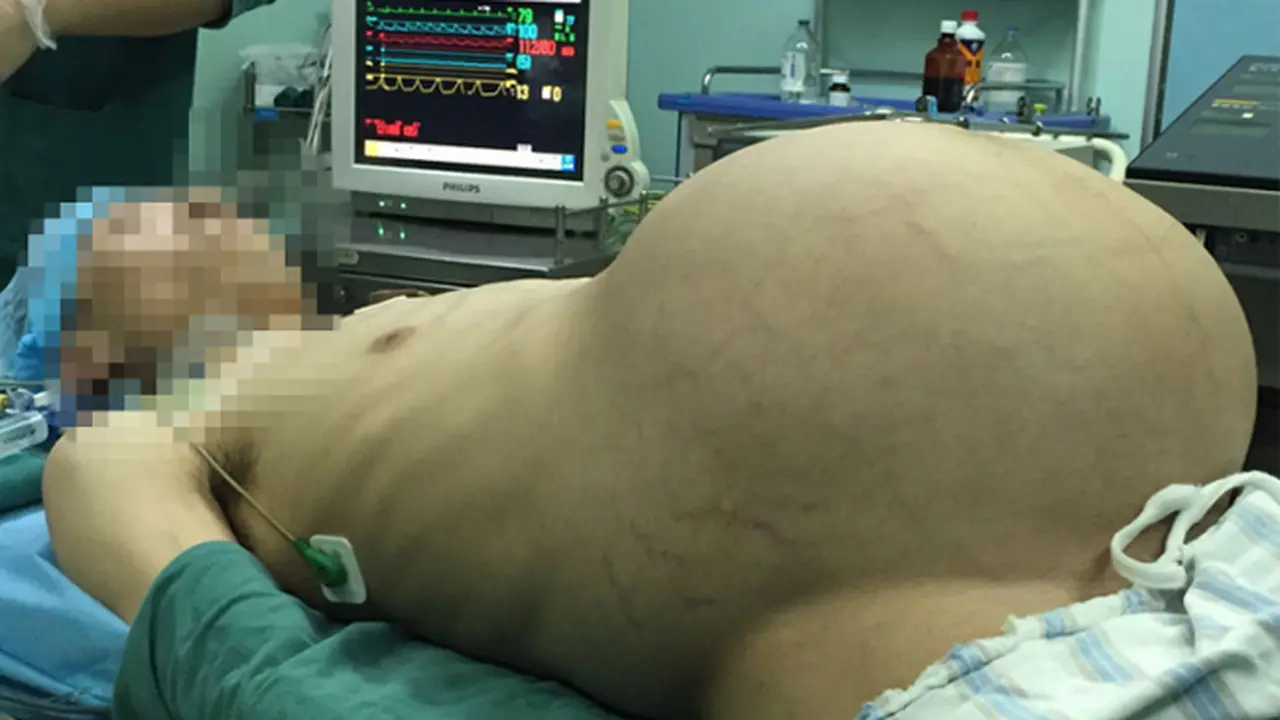 Bak Hamil 9 Bulan, Pria Ini Idap Tumor Selama 10 Tahun