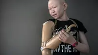 Nestapa Albino di Afrika, Bagian Tubuh Diincar untuk Jimat