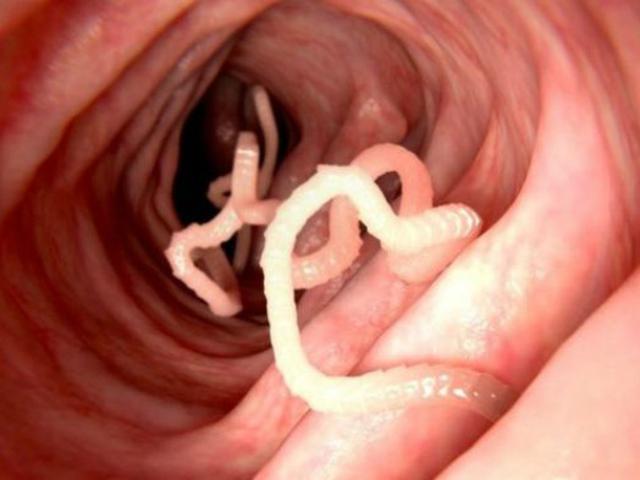 10 Tahun Sakit Perut Ada Cacing Parasit 30 Cm Dalam Perut Wanita Health Liputan6 Com