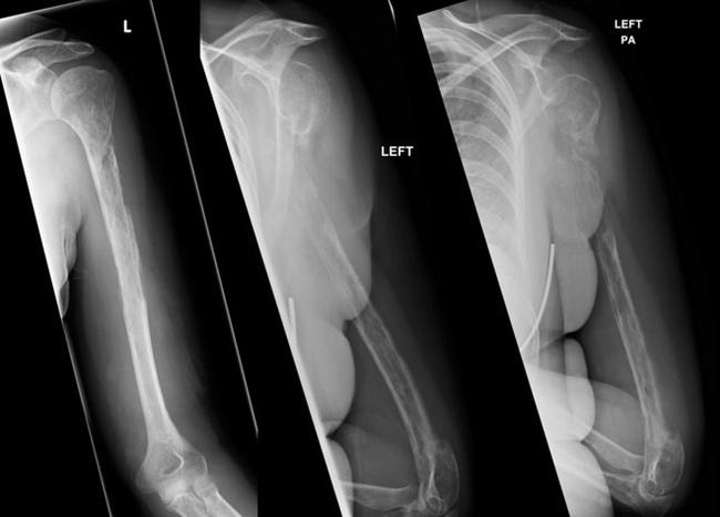 Hasil sinar X pada tulang lengan wanita penderita kondisi langka Gorham-Stout/copyright medicalnewstoday.com