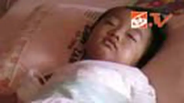 Balita Tercebur ke Panci Air Panas