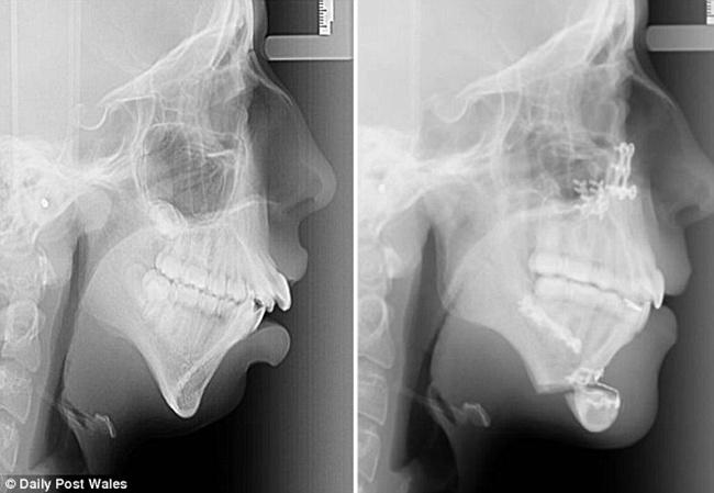 Hasil foto scan kondisi gigi dan dagu Ellie sebelum sama sesudah operasi | Photo: Copyright asiantown.net