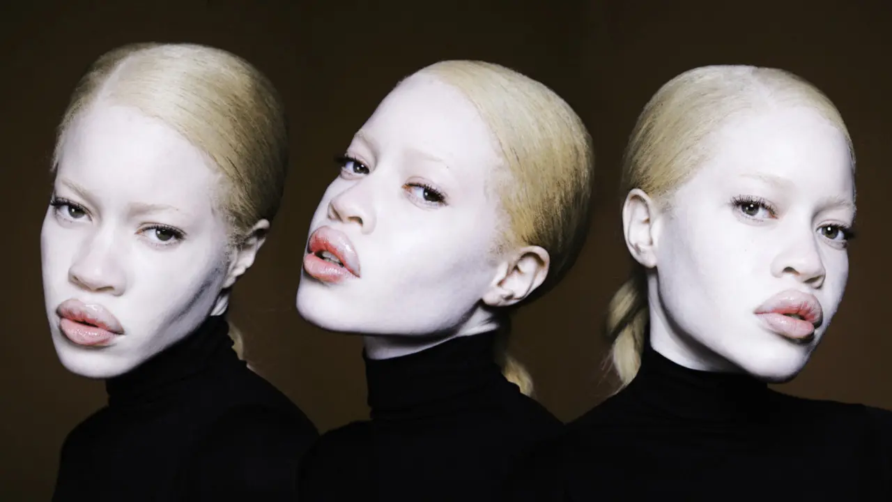 Meski Menderita Albino, 10 Model Ini Sukses Mendunia