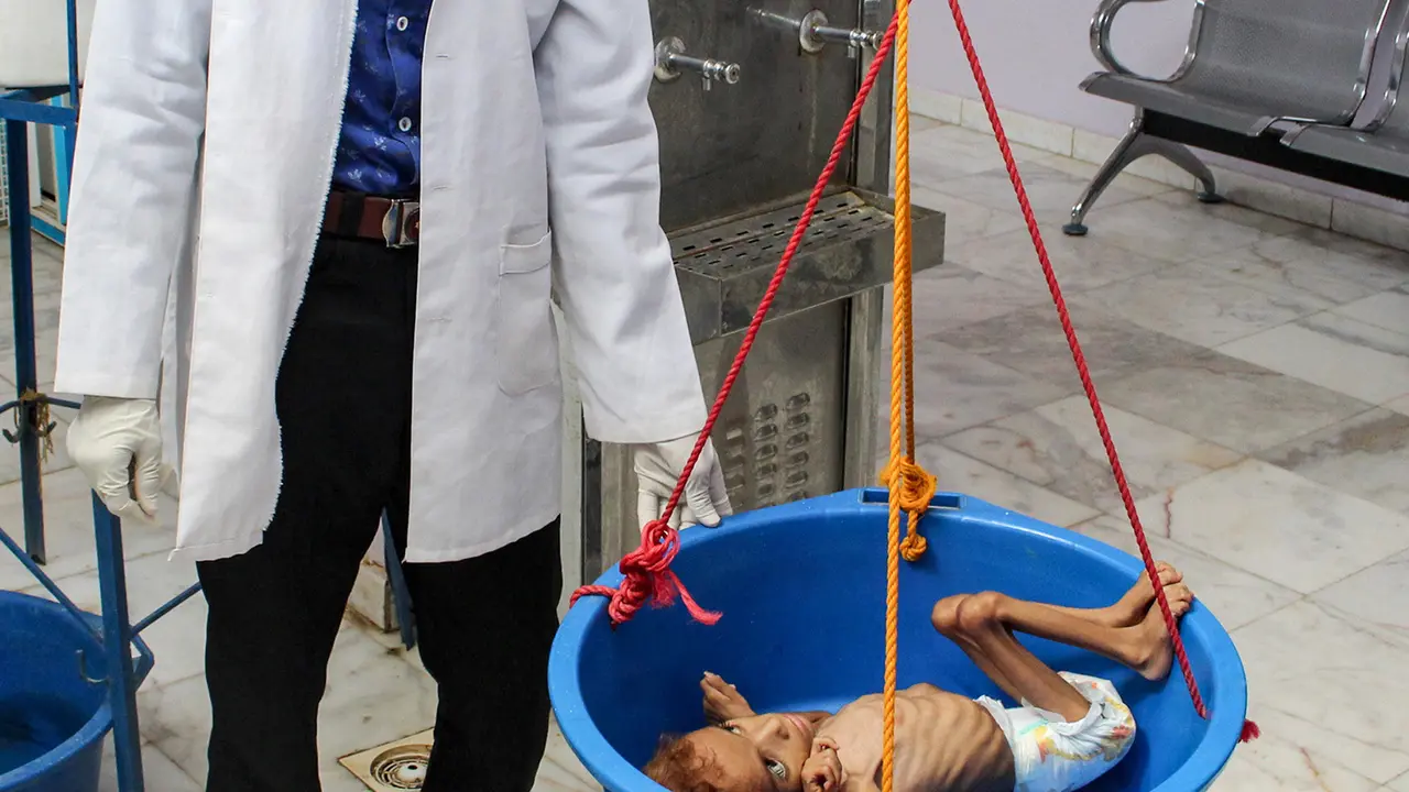 Perang Panjang, 5 Juta Lebih Anak Yaman Terancam Kelaparan Akut
