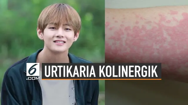 Kenali Urtikaria Kolinergik yang Dialami V BTS