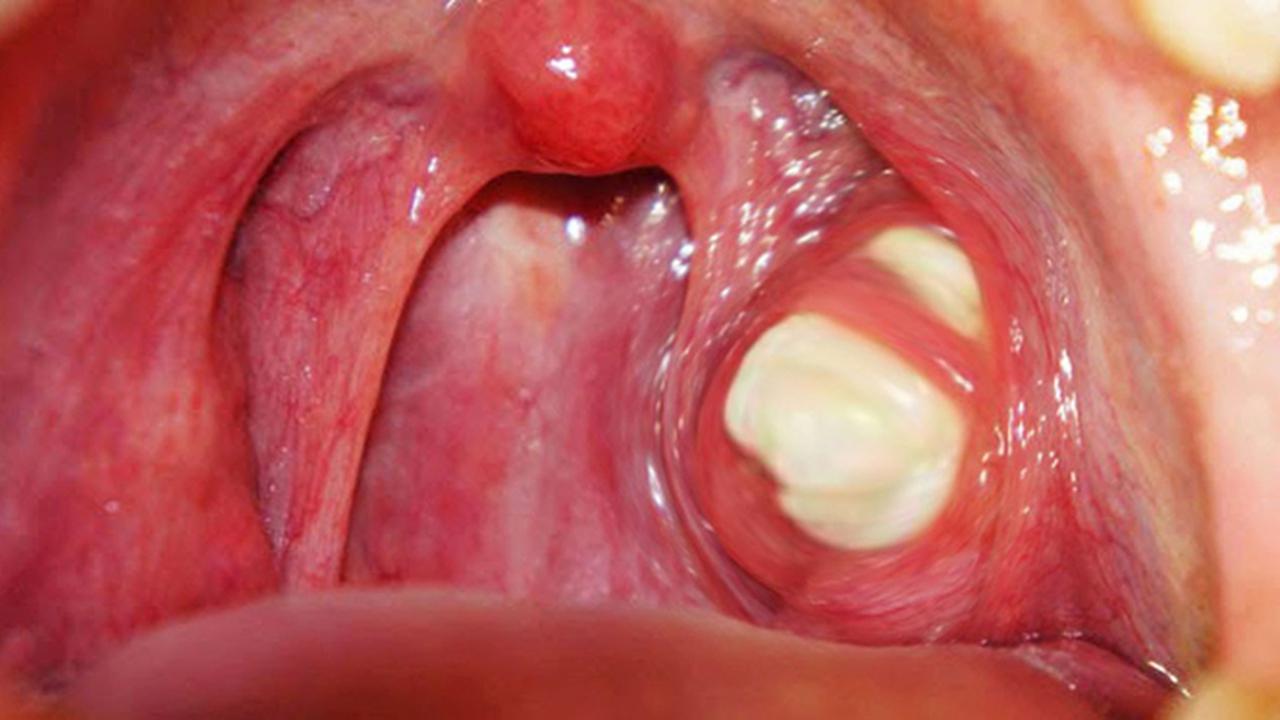 14 Ciri-Ciri Amandel dan Peradangannya, Simak Pula Cara Mengobatinya