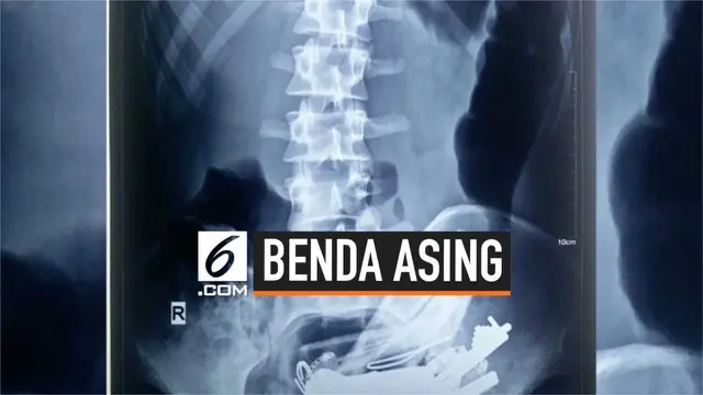 VIDEO: Dokter Temukan 80 Benda Asing dari Perut Pria India