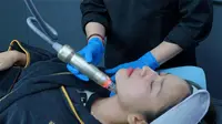 Inovasi dalam dunia perawatan kulit terus hadir. Salah satunya teknologi perawatan kulit yang menggabungkan microneedling konvensional dengan radiofrekuensi (RF) canggih.