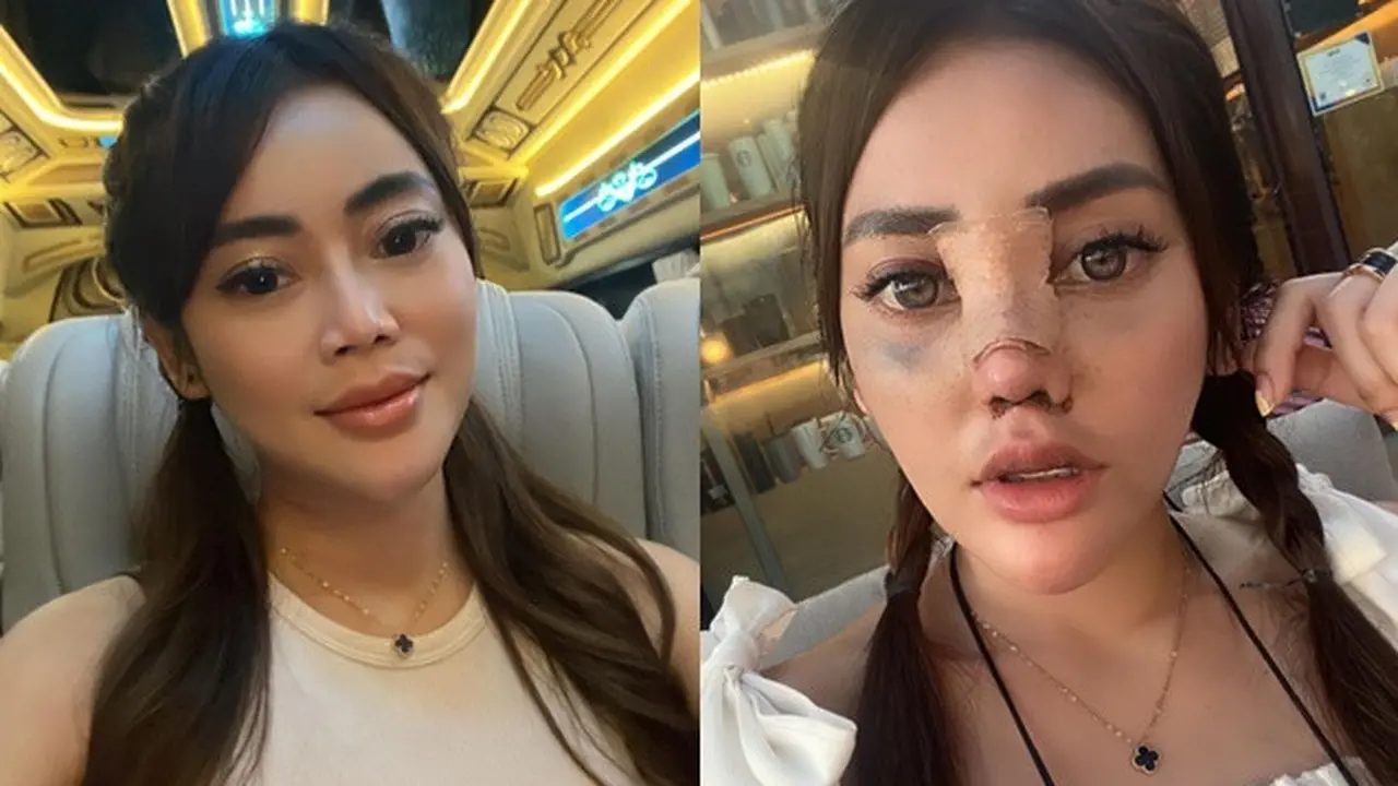 6 Potret Daniar MasterChef Usai Operasi Hidung, Jadi Sorotan