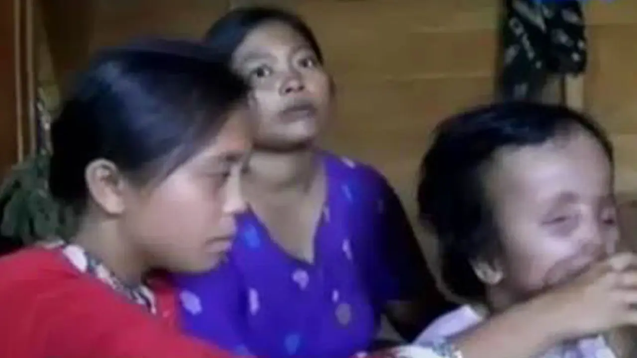 VIDEO: Sakinah, Bocah Penderita Hidrosefalus Ini Butuh Bantuan