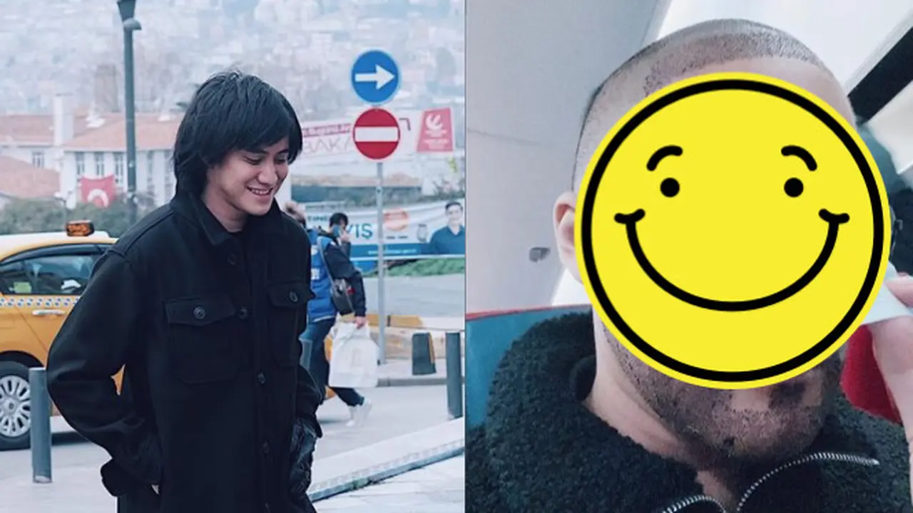 Potret Kevin Aprilio Jalani Transplantasi Rambut