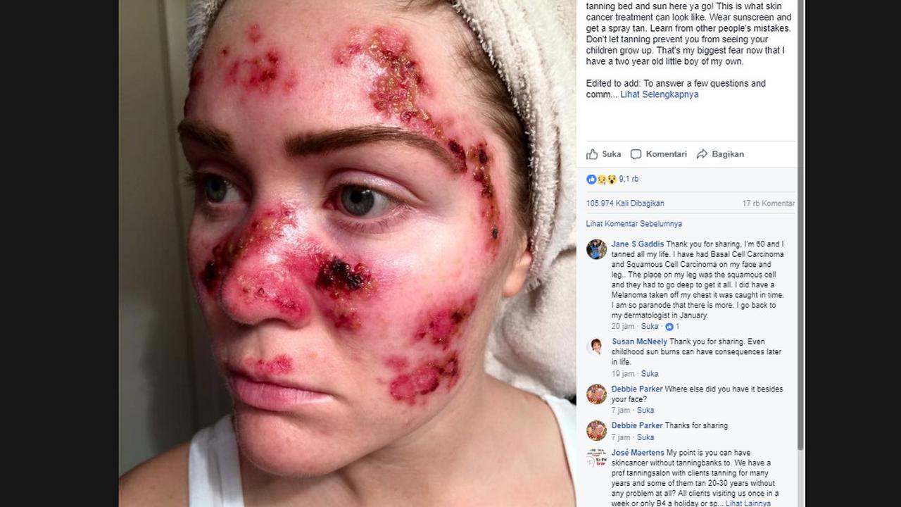 Wanita ini Berani Selfie Untuk Tingkatkan Kesadaran Kanker Kulit